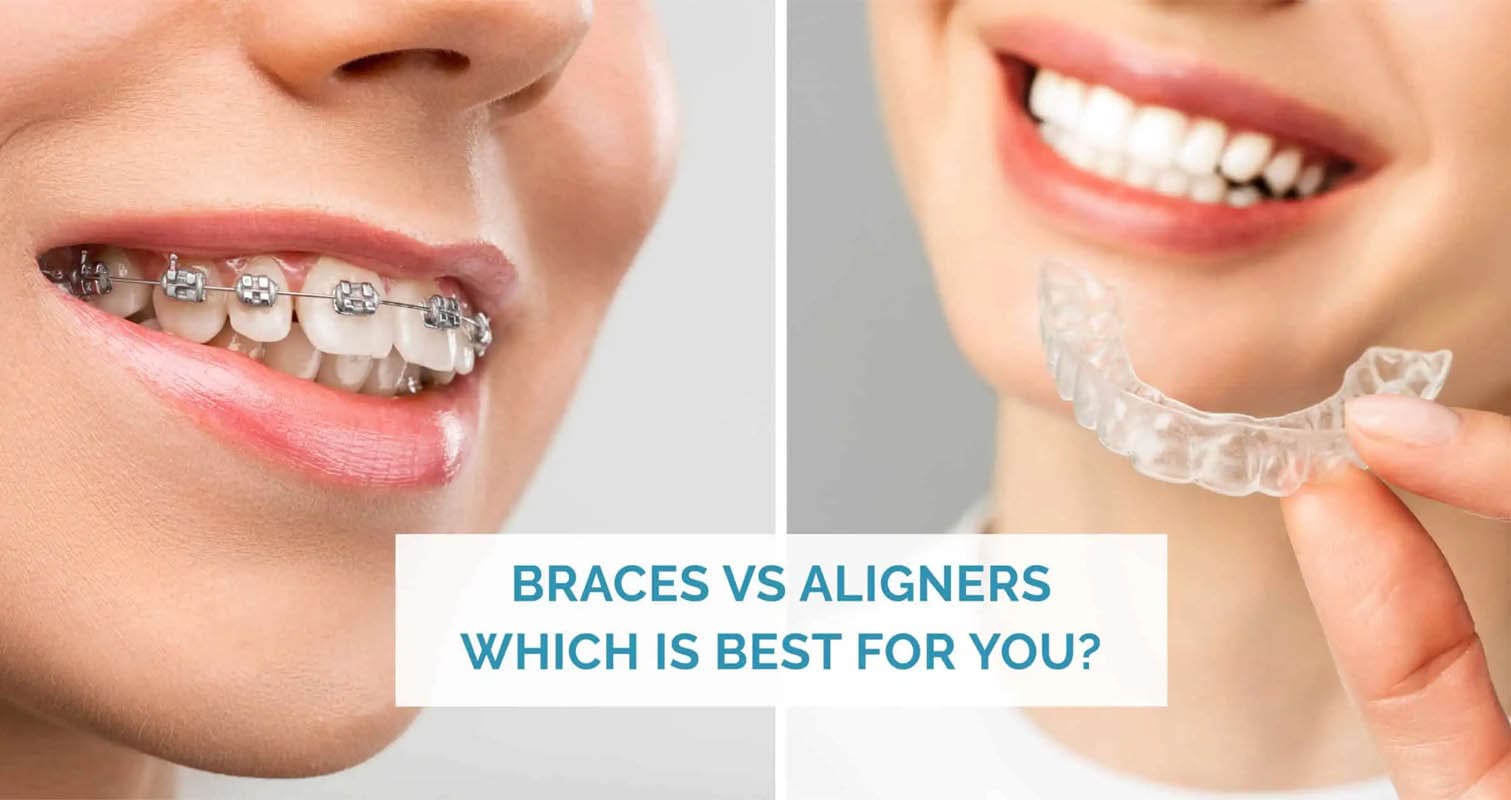 braces-and-aligners