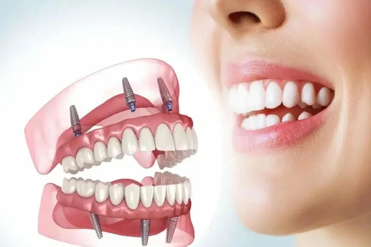 full-mouth-rehabilitation