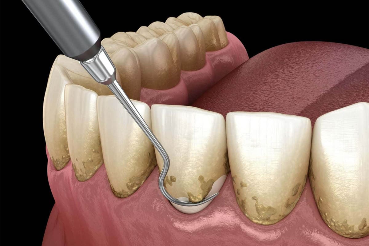 scaling-and-polishing