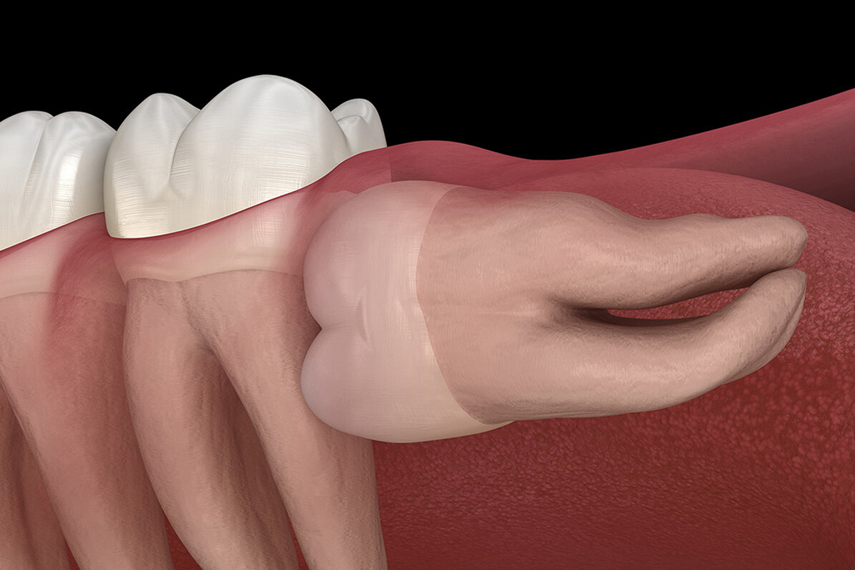oral-surgery-wisdom-tooth-extraction