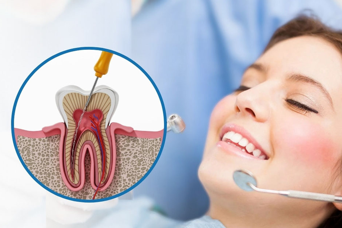 root-canal-treatment